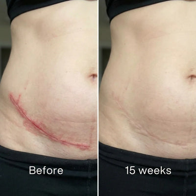 Ageoro™ Scar Solutions Silicone Stick